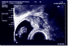 Ultrasound Scan Art Print 15 x 10 cm - Black / blue