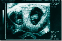 Ultraschallbild Kunstdruck 15 x 10 cm - Schwarz / Türkis