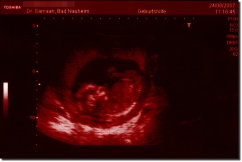 Ultraschallbild Kunstdruck 60 x 40 cm - Schwarz / Rot